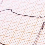 Troubles du rythme cardiaque