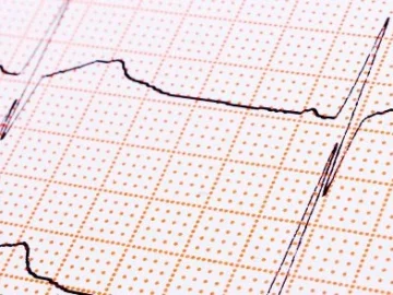 Troubles du rythme cardiaque