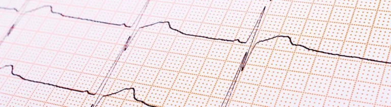 Troubles du rythme cardiaque